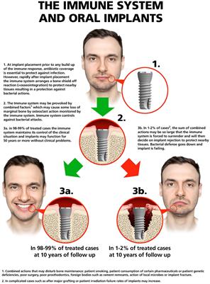 Osteoimmune regulation underlies oral implant osseointegration and its perturbation